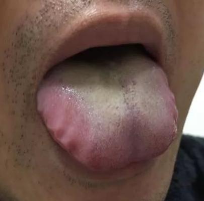 我们再看看这个舌头，齿印是有的，舌头胖大
那么他也符合齿痕+胖大舌的这个条件，也