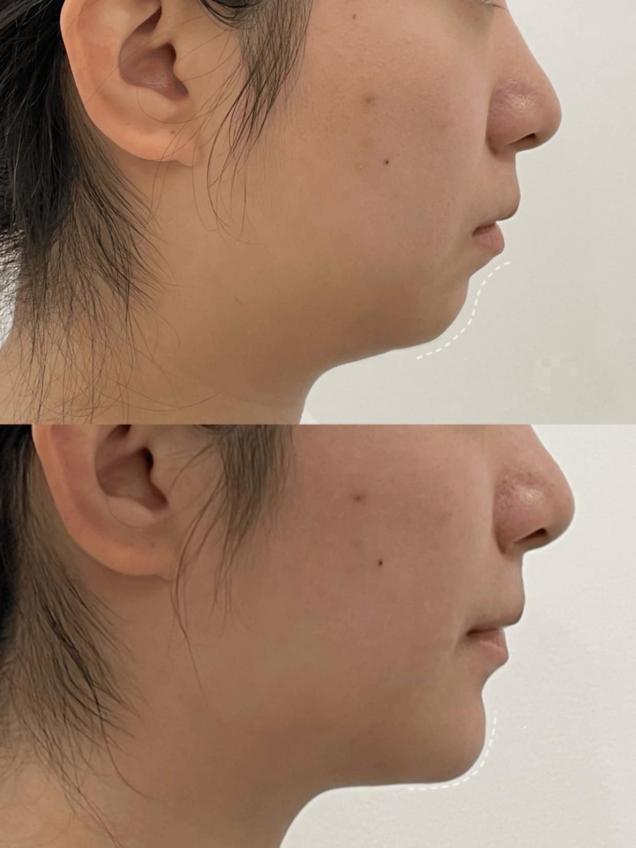 10岁女儿牙齿正畸术日记，第二篇：

截止上周六，女儿上牙套上牙箍已经过去四天，