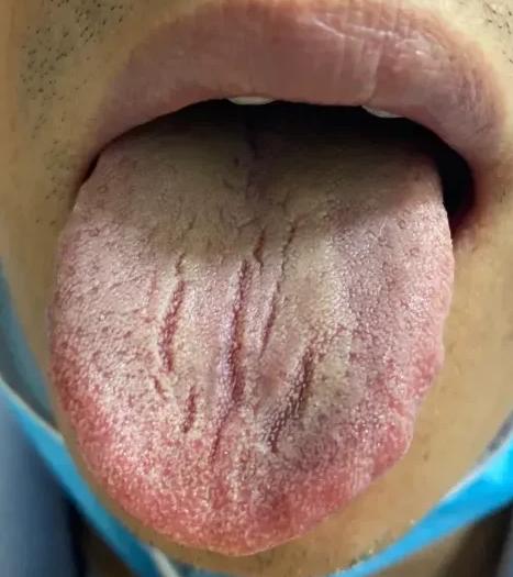 这样的裂纹舌，你以为只是脾虚湿盛？不怕不懂，就怕半吊子忽悠，害人又害己
 
舌中