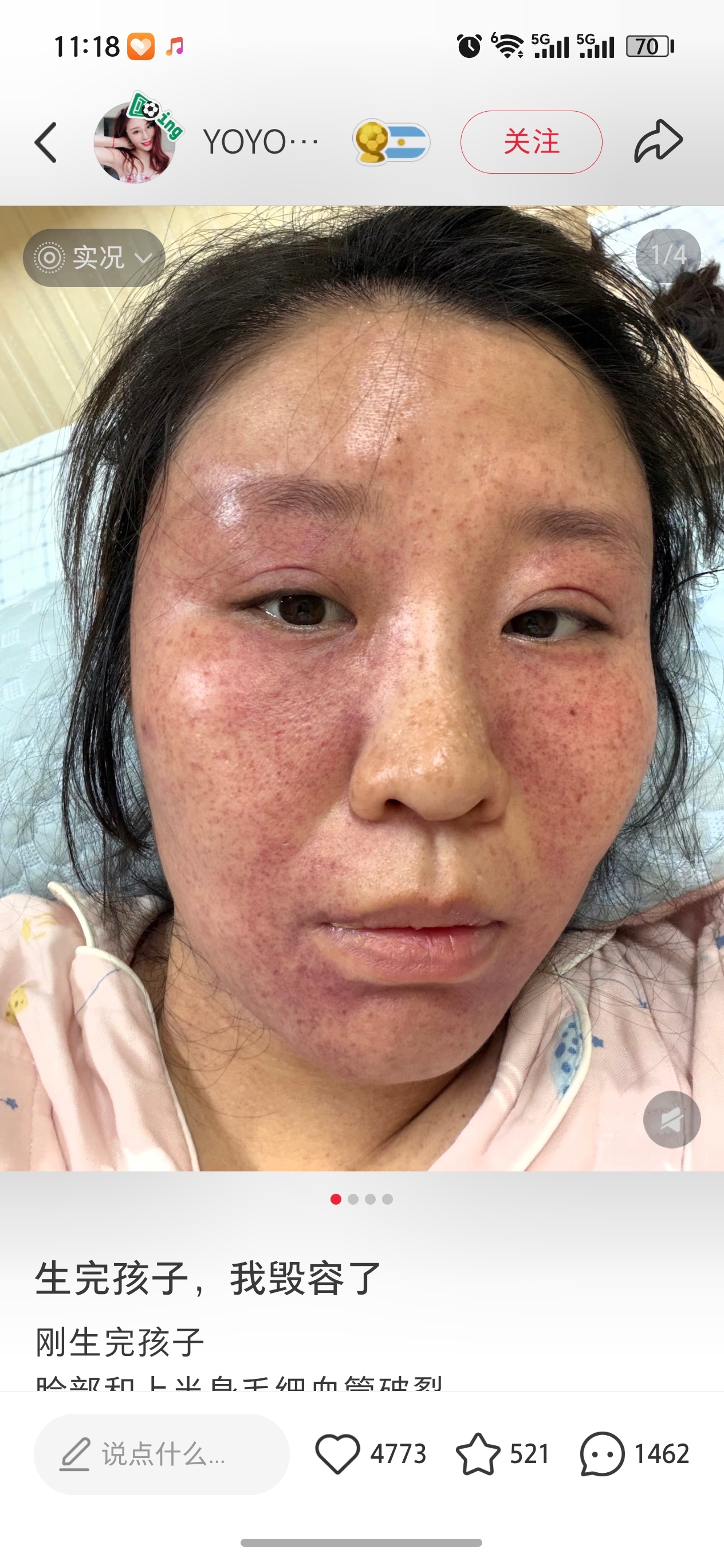 刷到这个博主她生了孩子脸上的毛细血管全炸了，我的天，还好后面恢复了，原来生孩子还