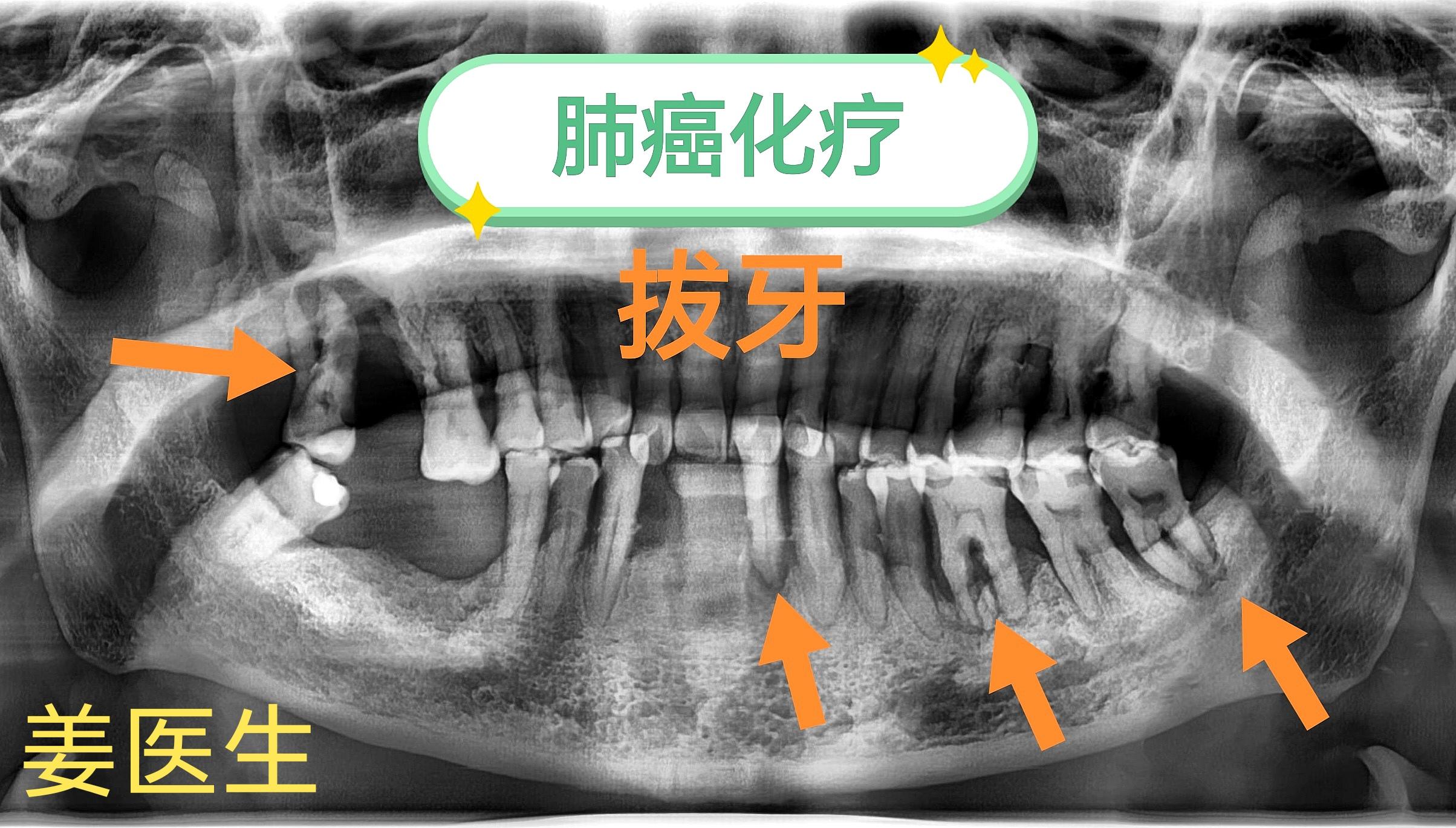 肺癌化疗期间，拔牙。
