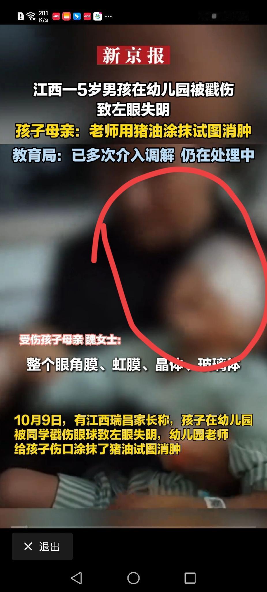 5岁娃左眼被戳瞎，
老师竟抹猪油“救场”？江西家长怒了！

“孩子哭着回来，我以