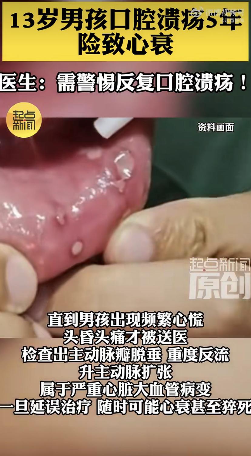 13岁男孩小洲，从8岁起就被口腔溃疡缠上了。嘴里，舌头上轮番溃烂，隔一两个月就发