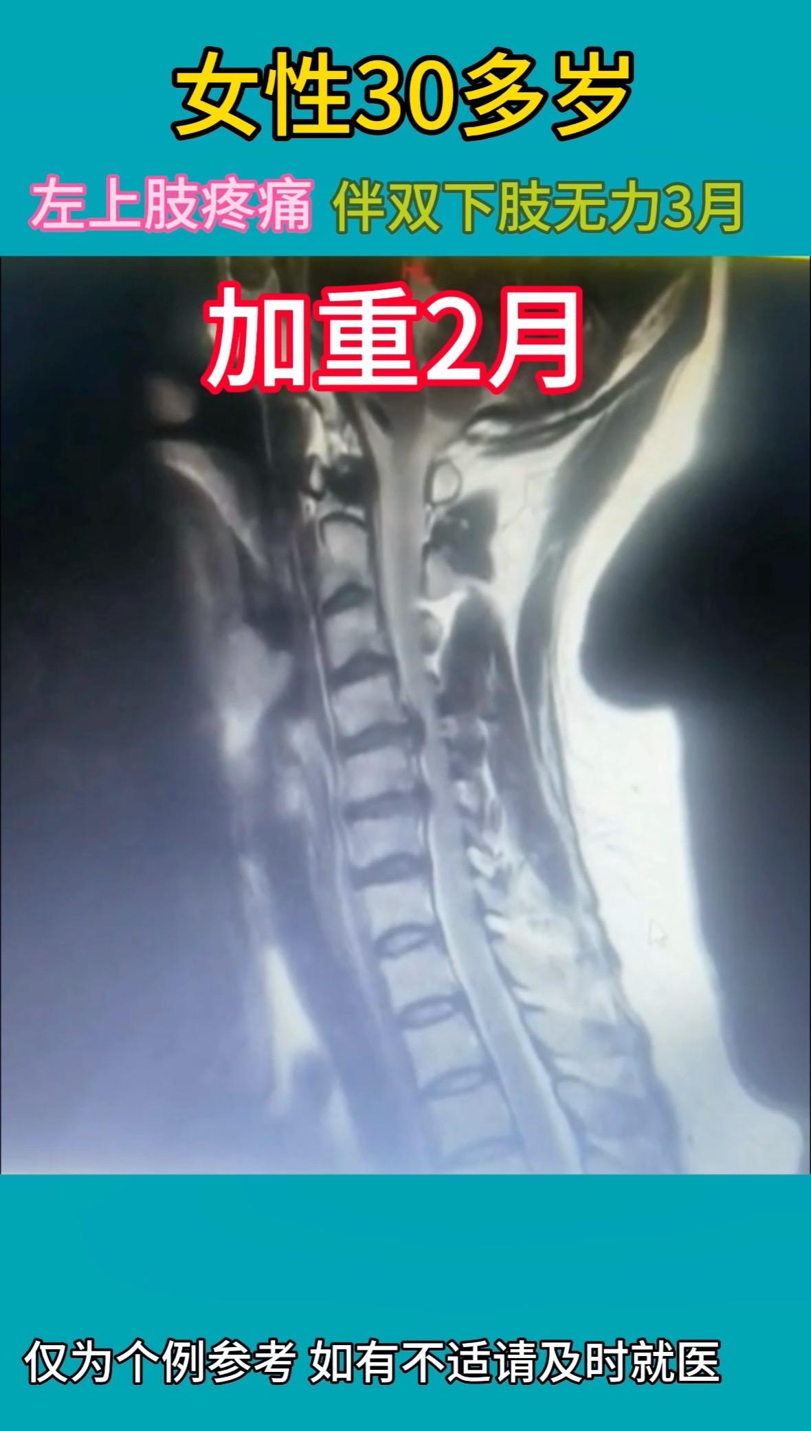 30多岁女性，左上肢疼痛伴双下肢无力3月，加重2周。前路微创行颈4/5...