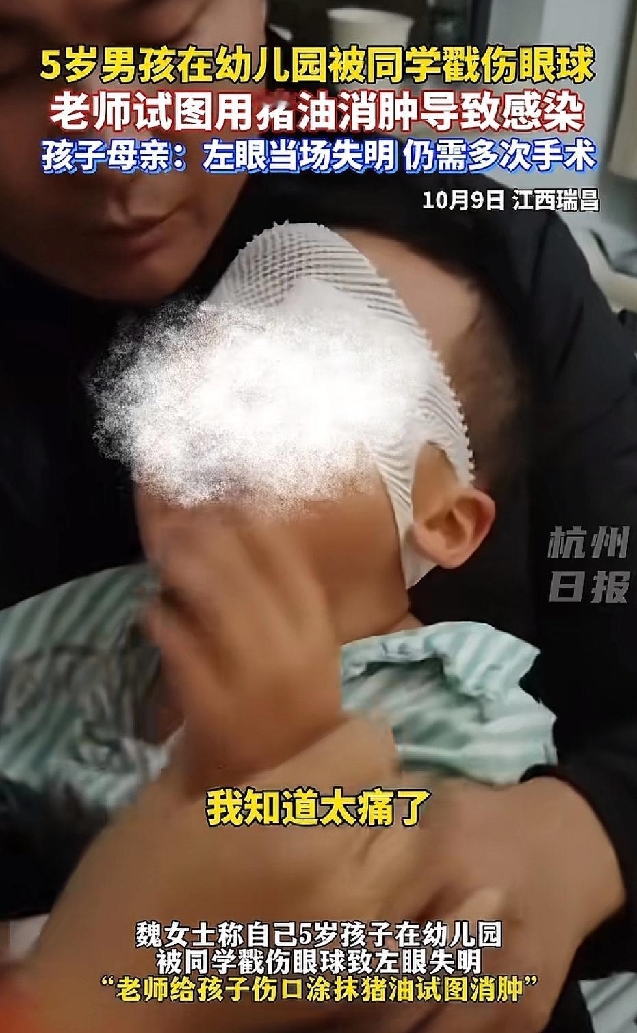 江西瑞昌，一名五岁男童在幼儿园被同学戳伤左眼球。令人意想不到的是，老师竟用猪油涂