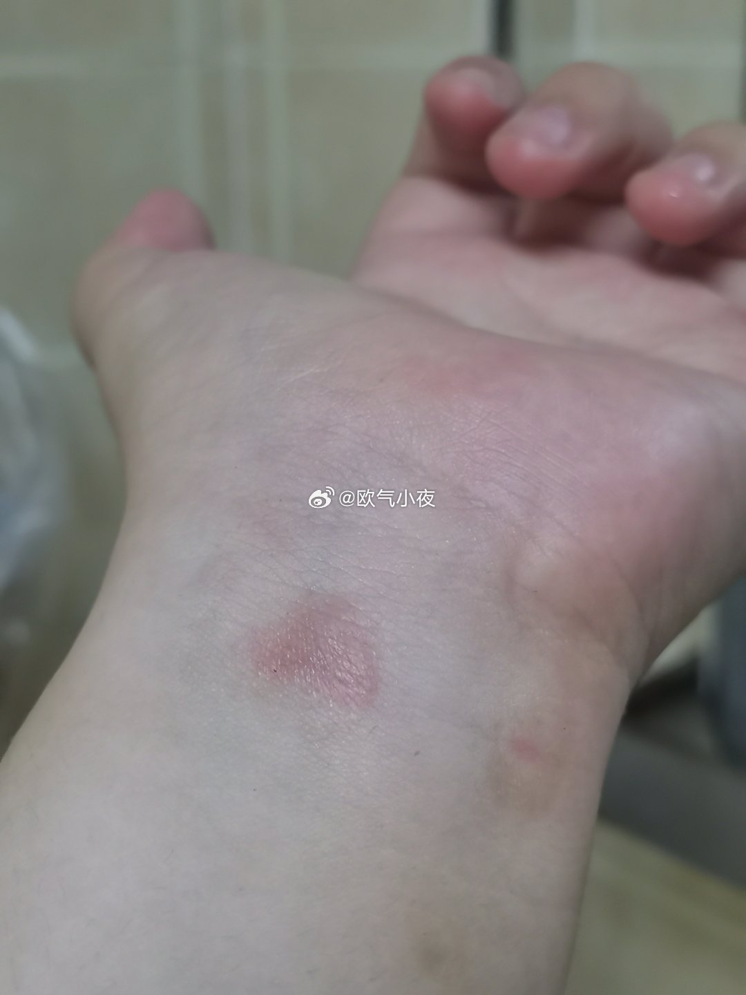 电子表我已畏惧。。想不到这里怎么会被烫伤的 