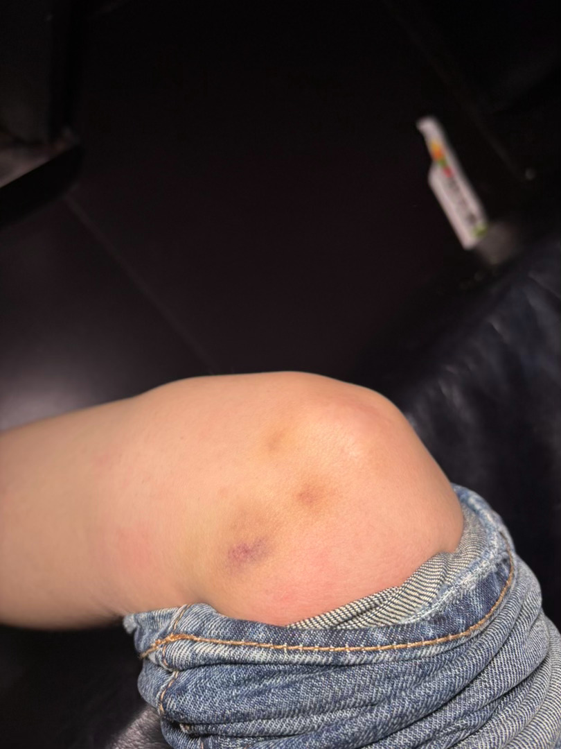 孩子们最近腿摔了 大腿旁边也一大块 最近有的互动姿势可能不太方便