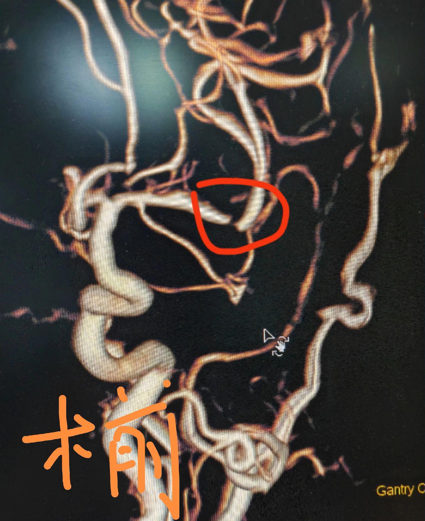 大脑中动脉重度狭窄，患者反复右侧肢体无力发作，行球囊扩张支架植入术，血...