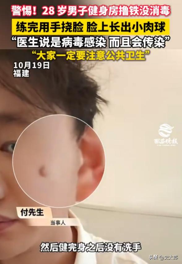 福建，28岁男子去健身房撸铁，练完没洗手也没消毒，顺手挠了挠脸，没过多久脸上竟冒