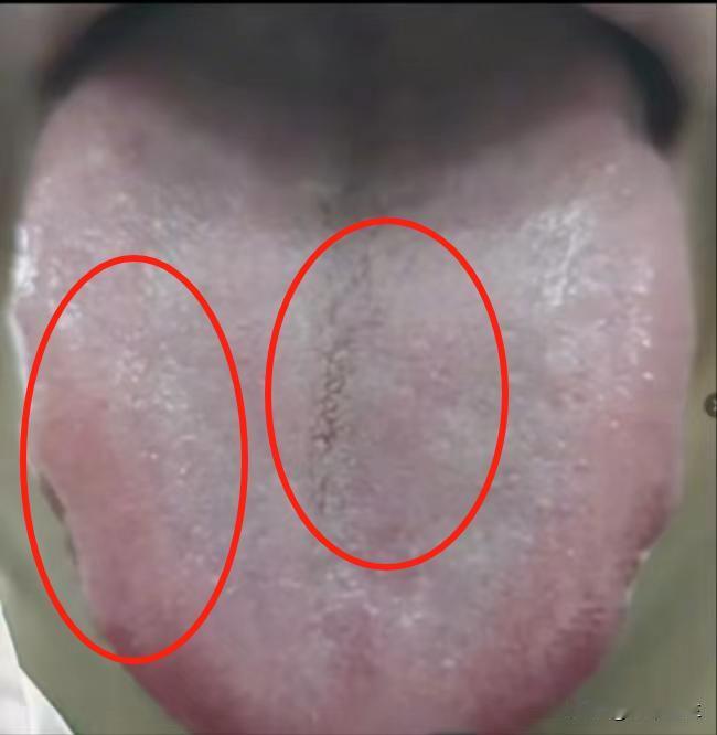 这种舌象最让人头疼，舌头裂纹又深又宽，好多人都误以为要补，其实越补越虚

主诉：