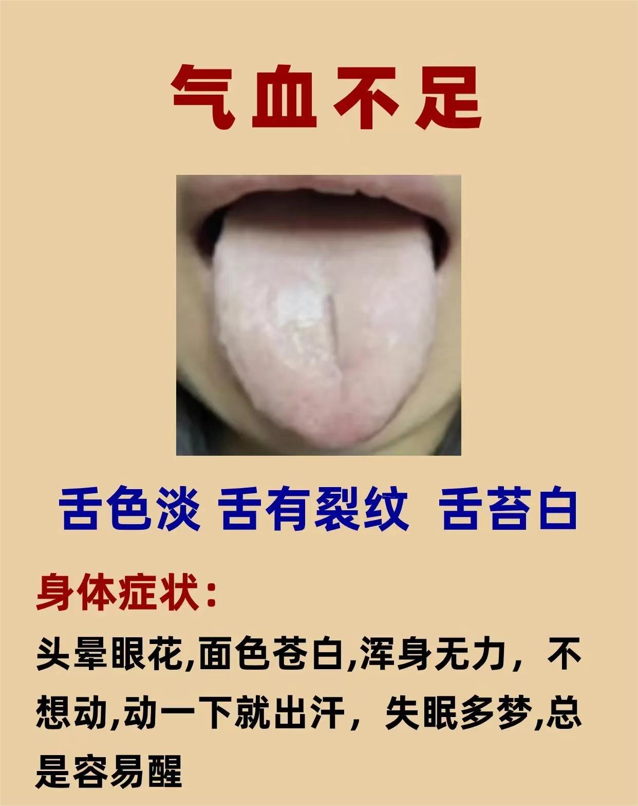 中医教你如何辨舌象知健康，这六种典型舌象，对比一下，看你自己是属于哪一种？