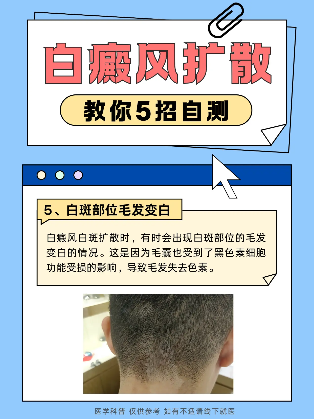 白癜风扩散的症状