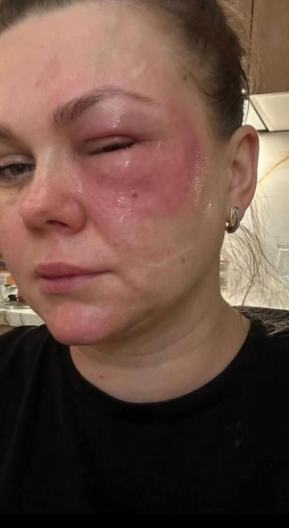 一种来自俄罗斯的新型美容潮流正在迅速流传：女性大量将“鲑鱼精液”注射到脸上，希望