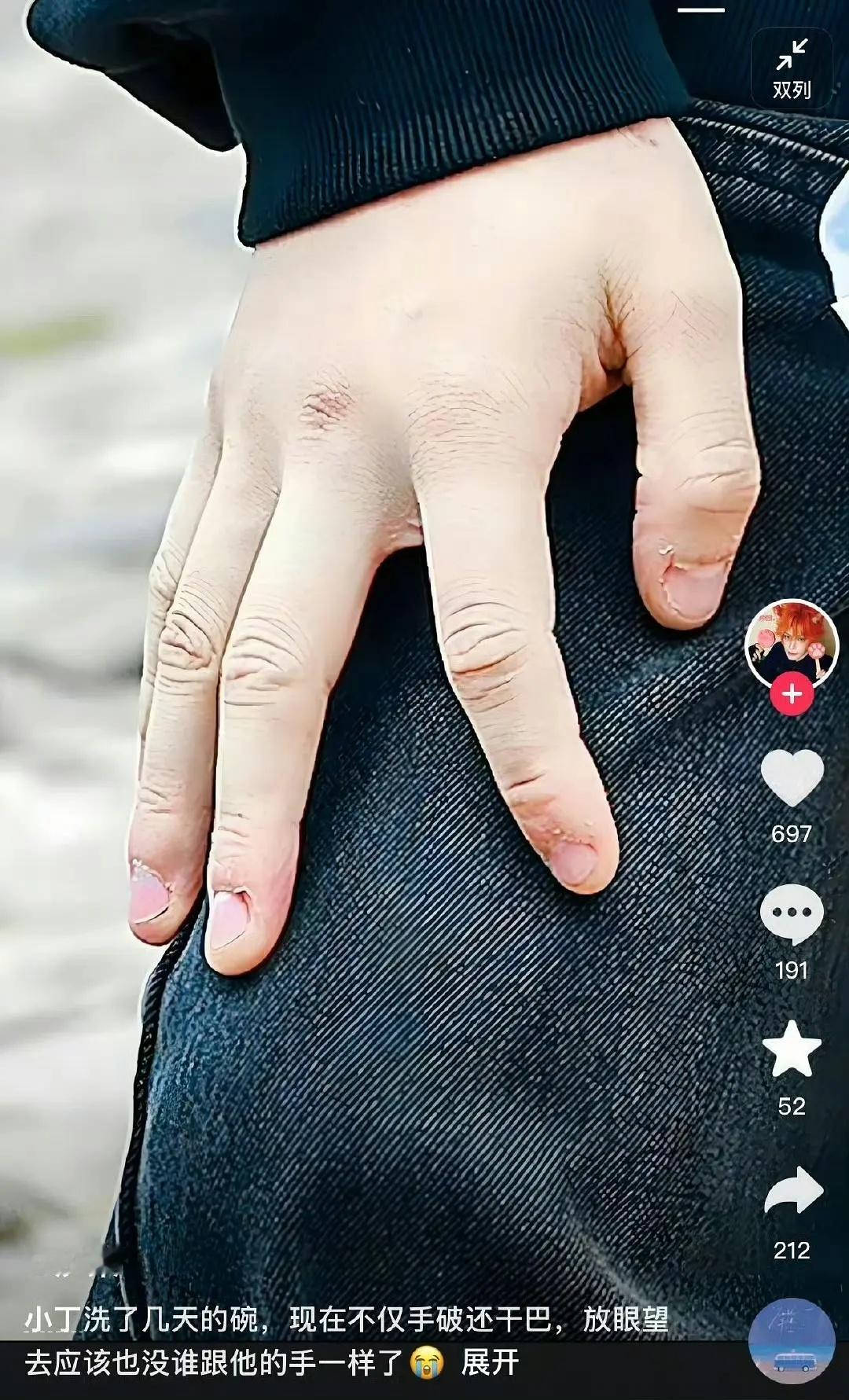 指甲咬到这种程度算强迫症了吧 ​​​