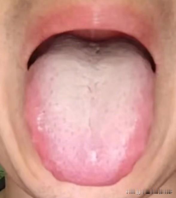 这种舌象，很多人不是清热降火，就是健脾化痰，简直是拆东墙补西墙，大错特错！

舌