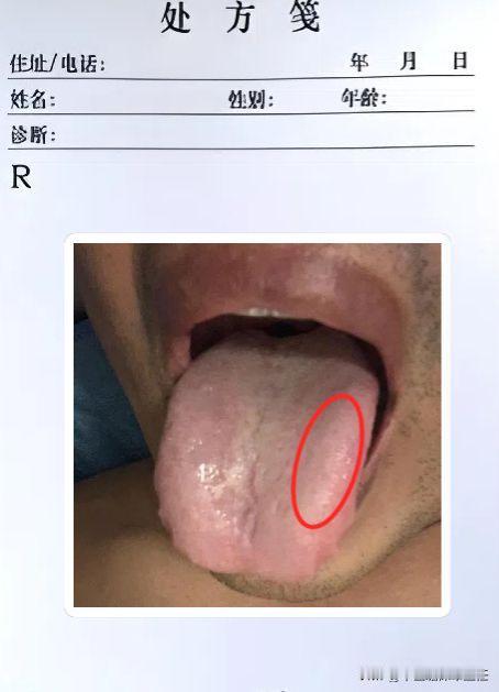 碰到这种“无底洞”舌象，先别健脾了，第一步要疏肝！

门诊上碰到的一个小伙子，说