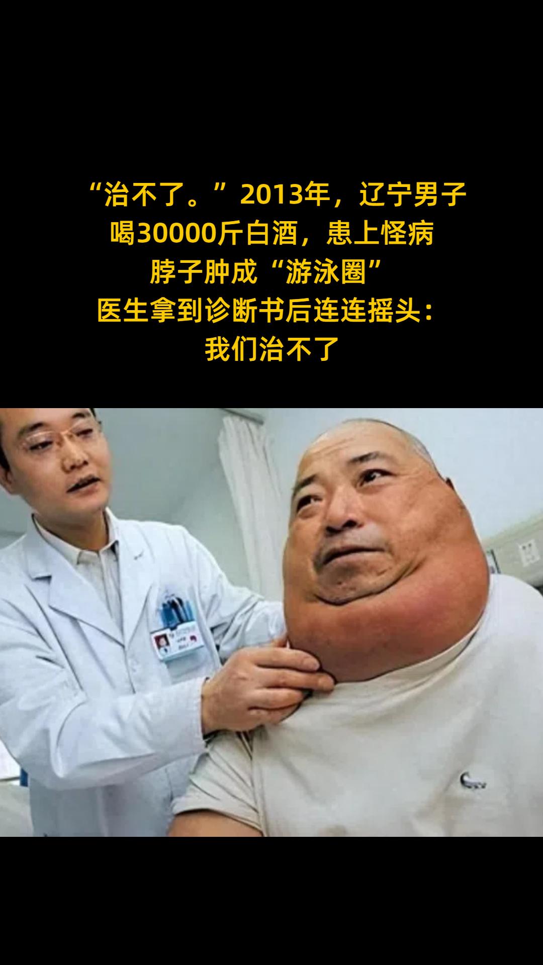 “治不了。”2013年， 辽宁男子喝30000斤白酒， 患上怪病，脖子...