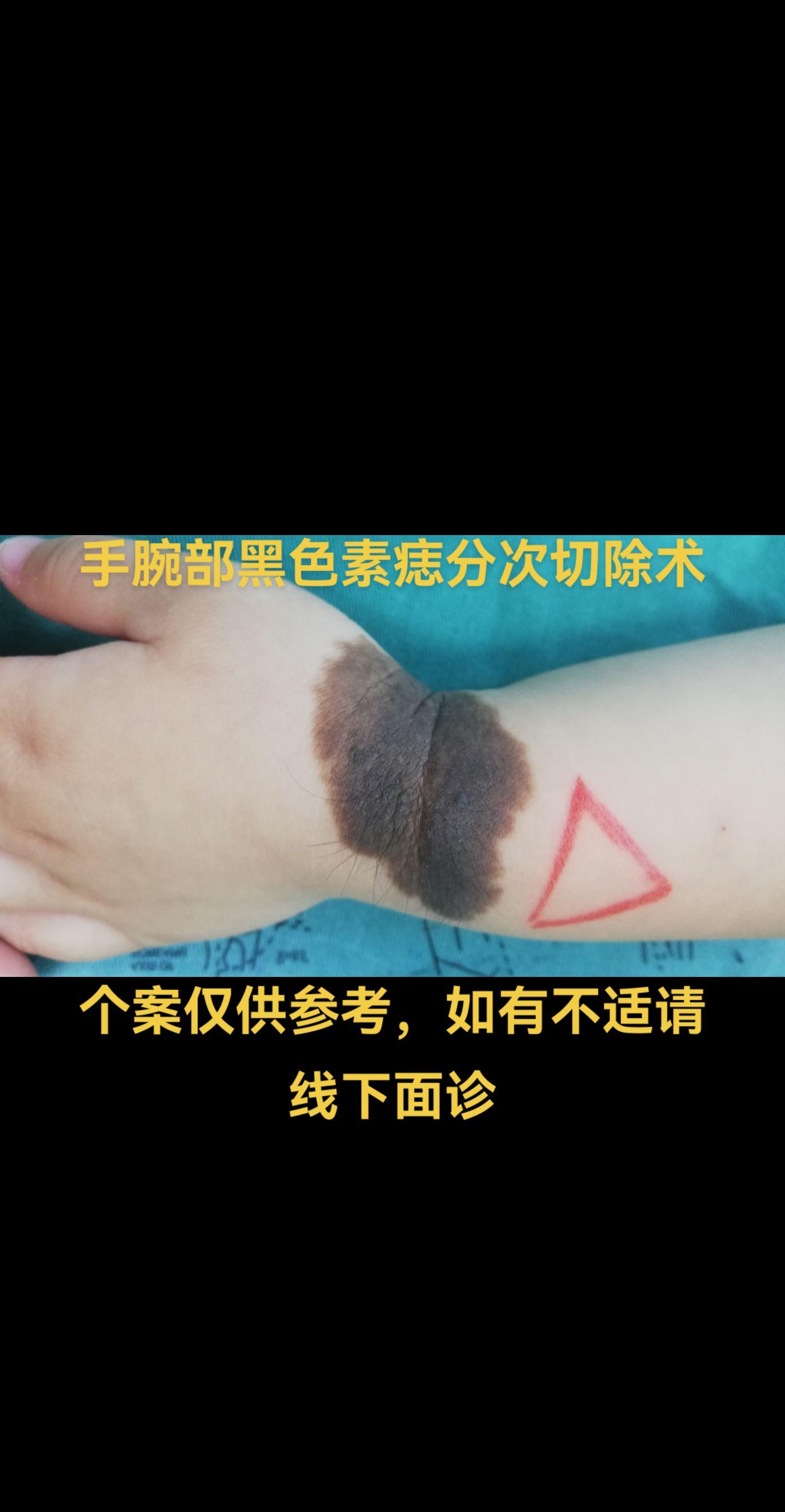 黑色素痣分次切除。特殊部位的巨大色素痣可以考虑分次切除。