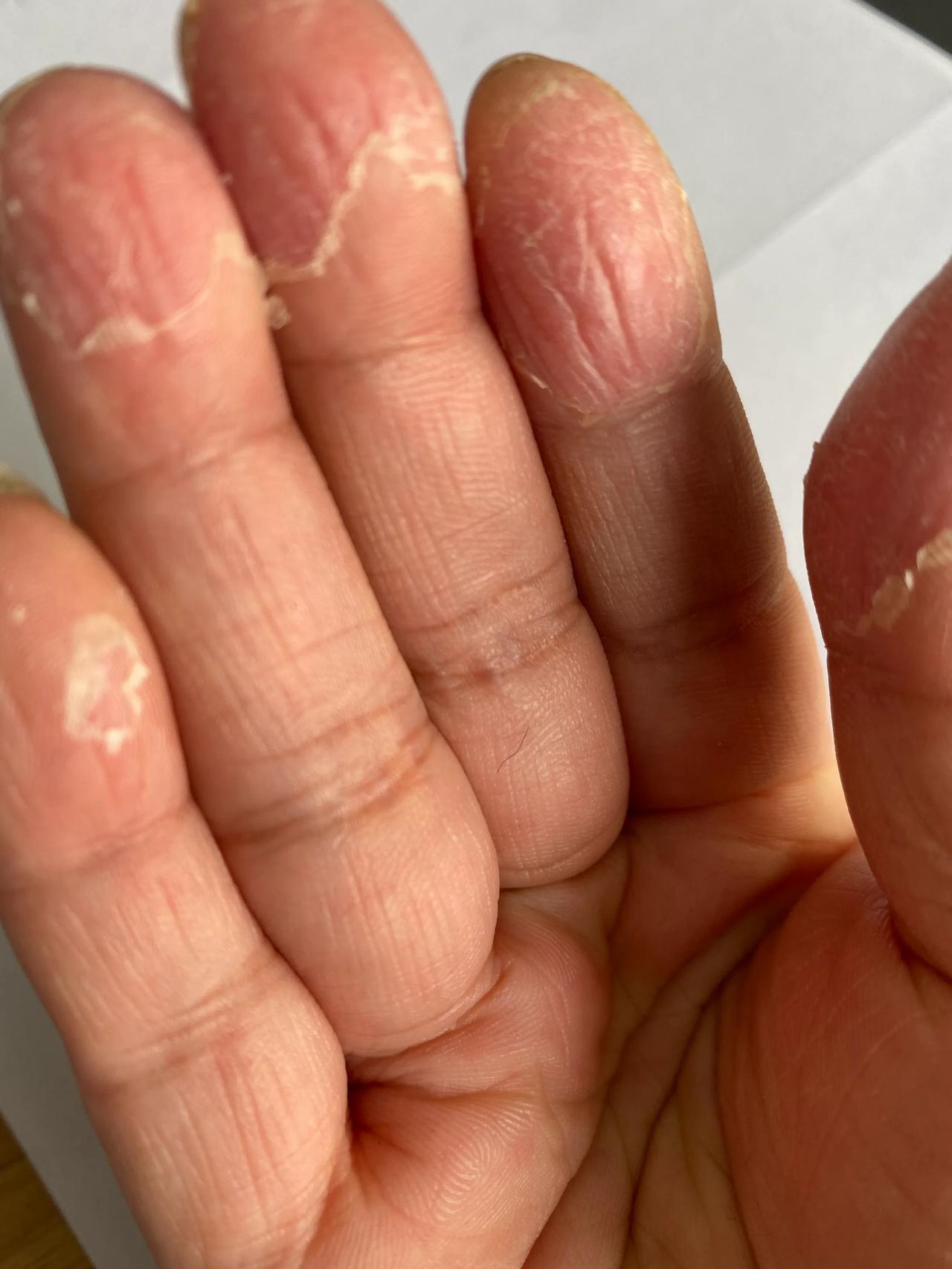 求秘方，脱皮严重，怎么回事