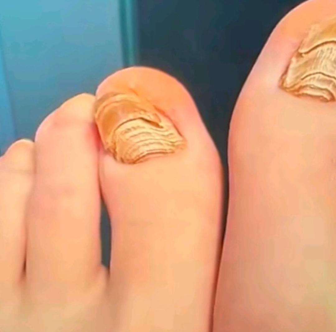 26岁女子穿袜子睡觉，睡出千层甲

杭州有个26岁的女生，一直都习惯穿着袜子睡觉