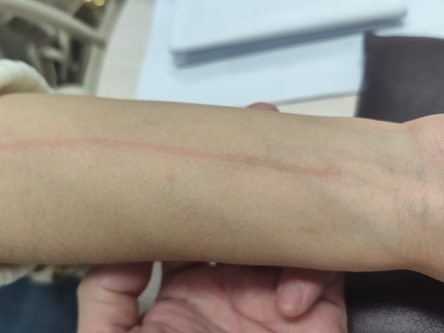 我的门诊故事  39岁女性，因为低热、颈部淋巴结肿大、伴见皮疹半年，来门诊咨询。