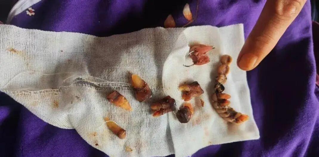 心寒！心脏四个支架的63岁老人，只看一颗牙，一辈子积蓄被私立口腔洗劫一空

看完