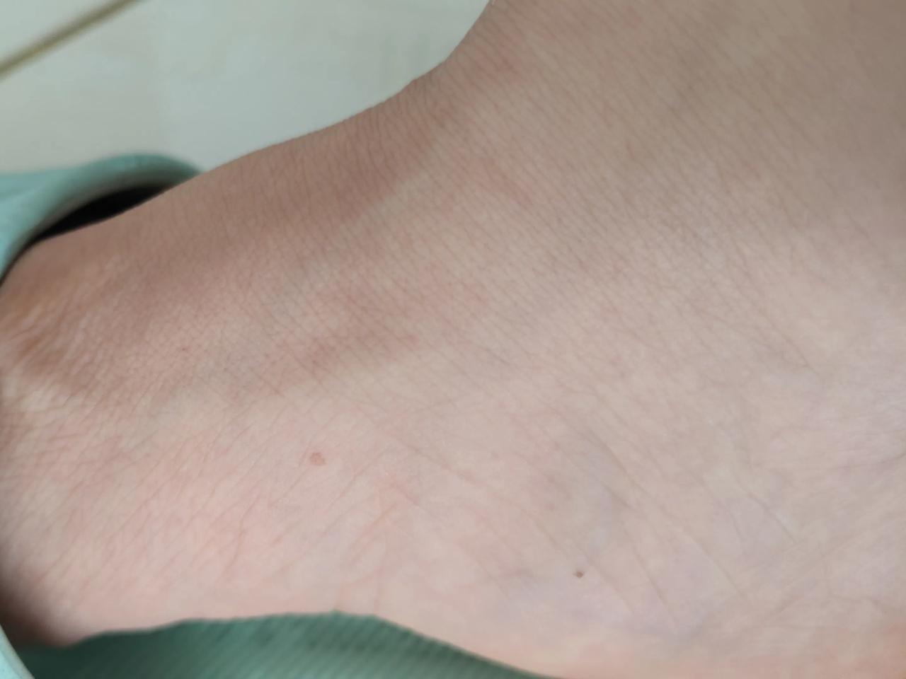 近一年发现脚上有了斑点，手上两个黑点是近二年有的，先长出一个，后又长出一个，这些