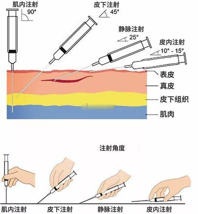 不同注射方式的区别 