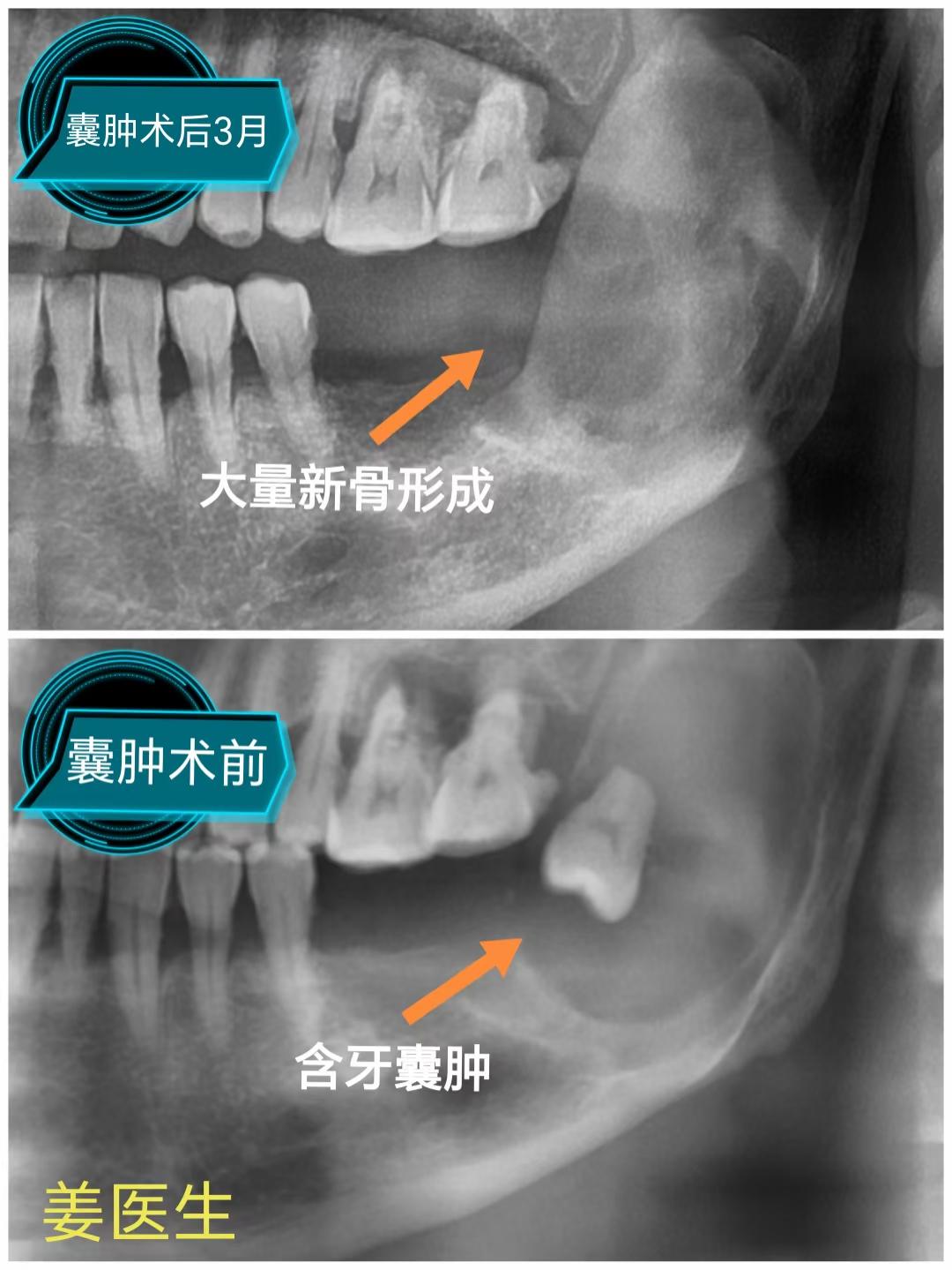 囊肿术后。两位囊肿患者术后复查，囊腔周边均形成了大量新生骨质！效果满意，每三个月复查，期待后期复查结果！