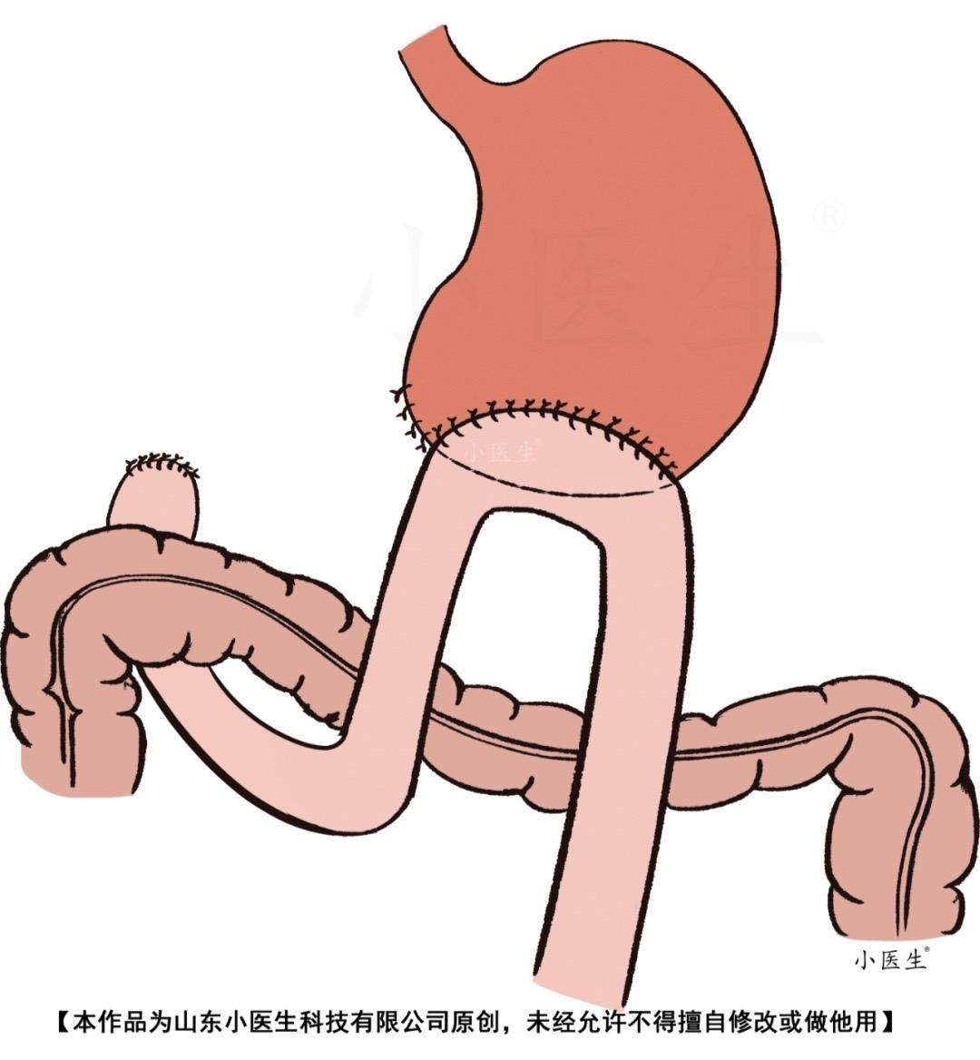 急诊床旁ERCP.83岁，胃大部分切除，胆管结石感染性休克，床旁无射线...