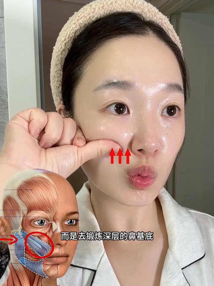 像这种凹进去的法令纹，正面看苹果肌下垂，侧面看鼻子就像陷进了皮肤里。不要只想着淡