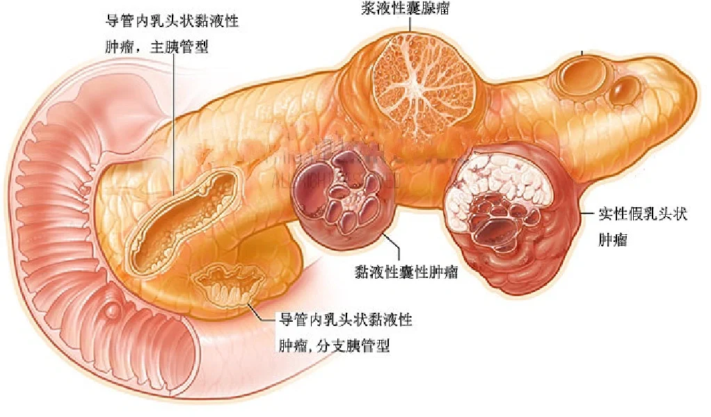一张图形象显示胰腺常见囊性肿瘤