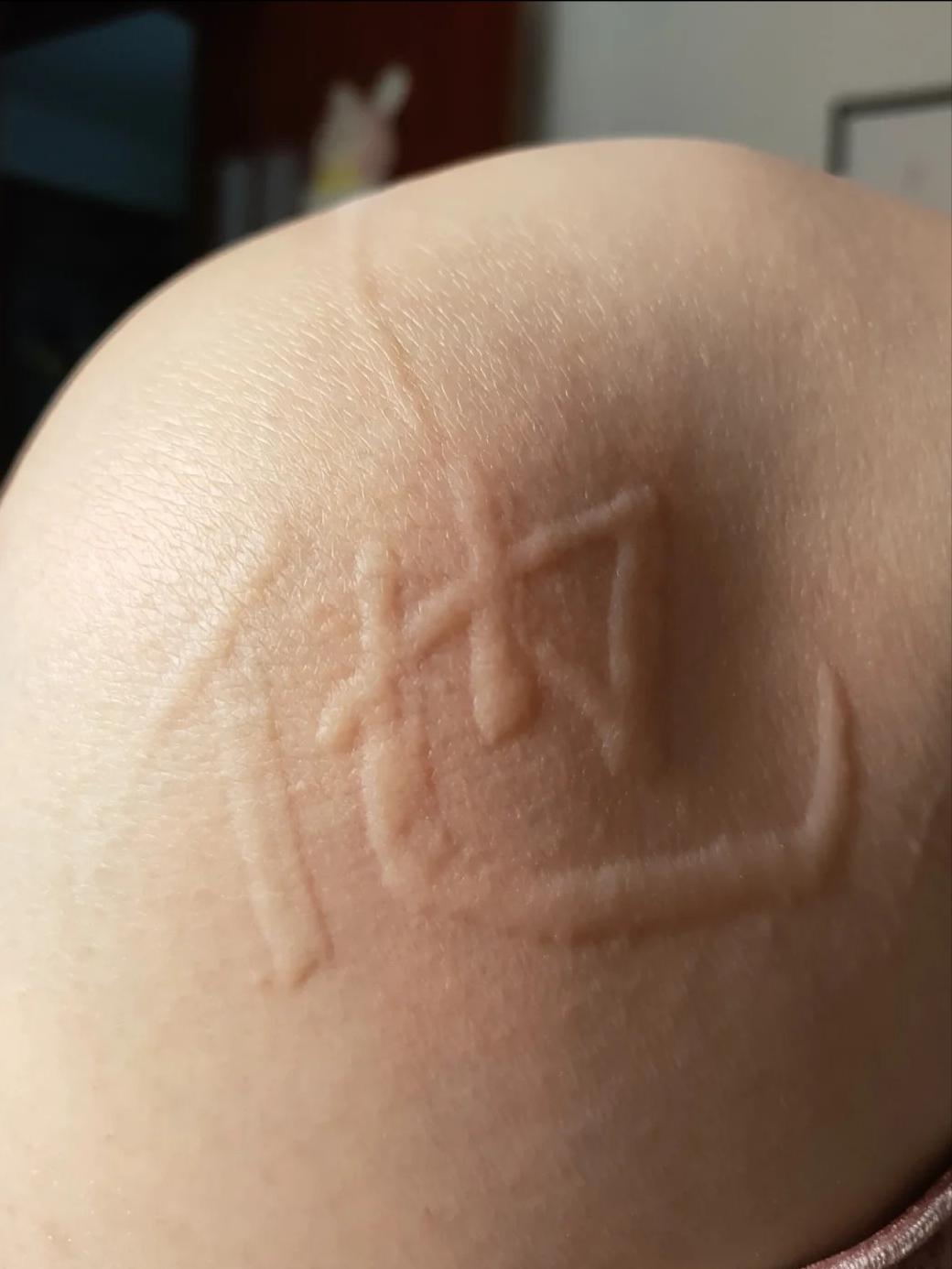 人工荨麻疹，身体也可以用来画画写字…

皮肤划痕症，也称为人工荨麻疹，是一种常见