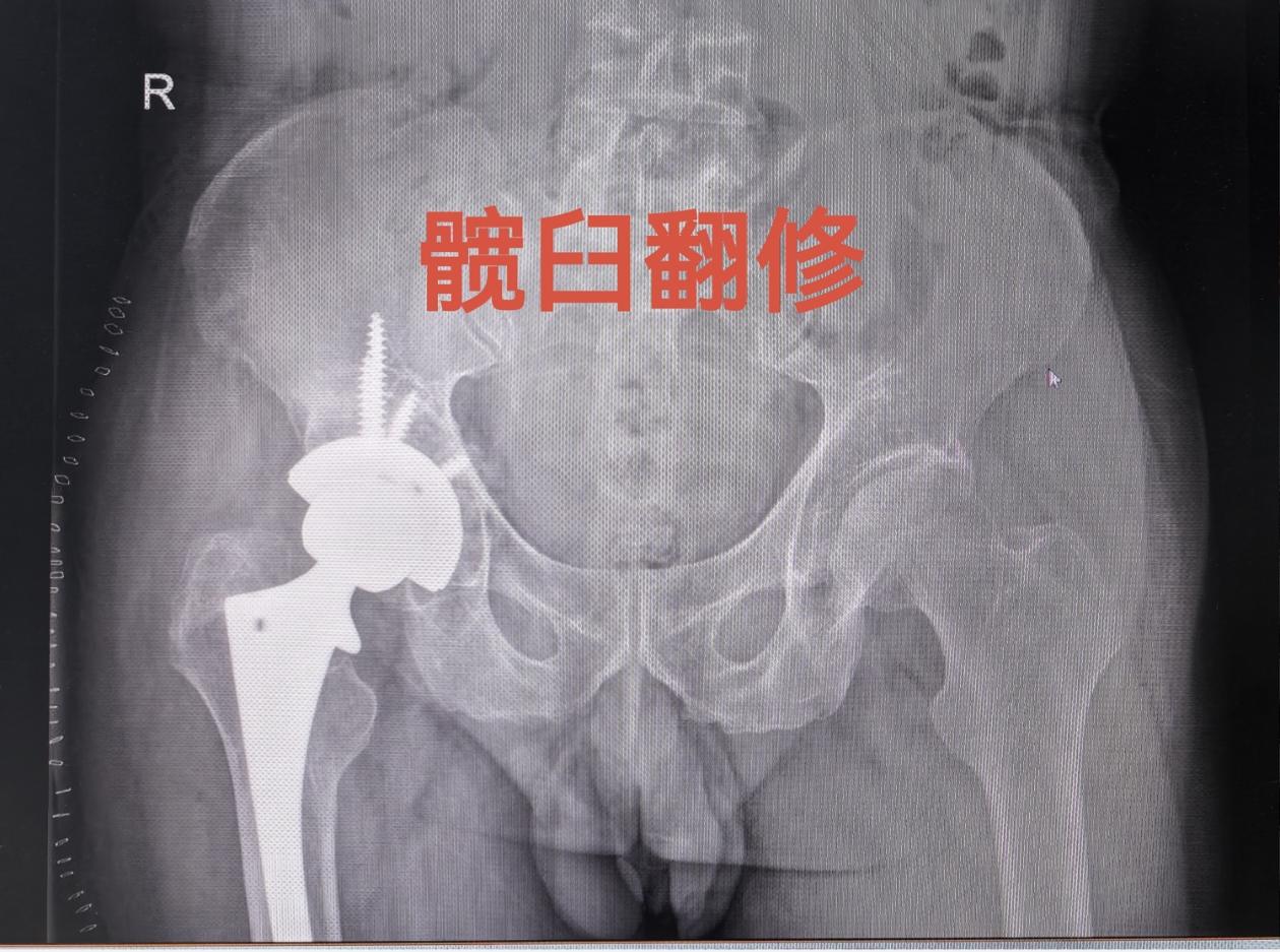 髋关节置换术后假体松动。髋关节置换术后假体松动，一定要做髋关节ct，此...