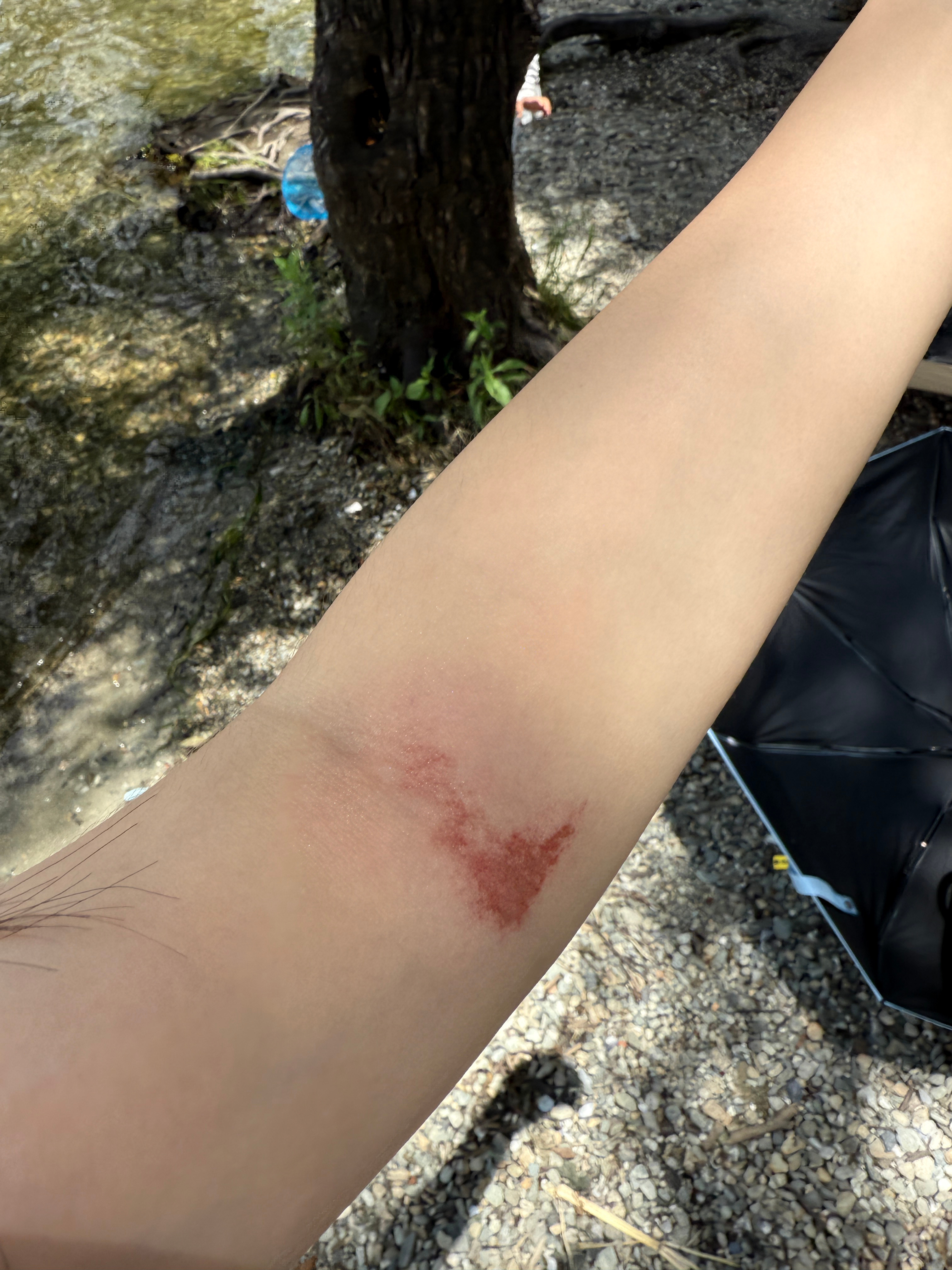 抓伤买什么膏药擦好的快呀，到云南第一天买的图2 擦了俩天还没好  ​​​