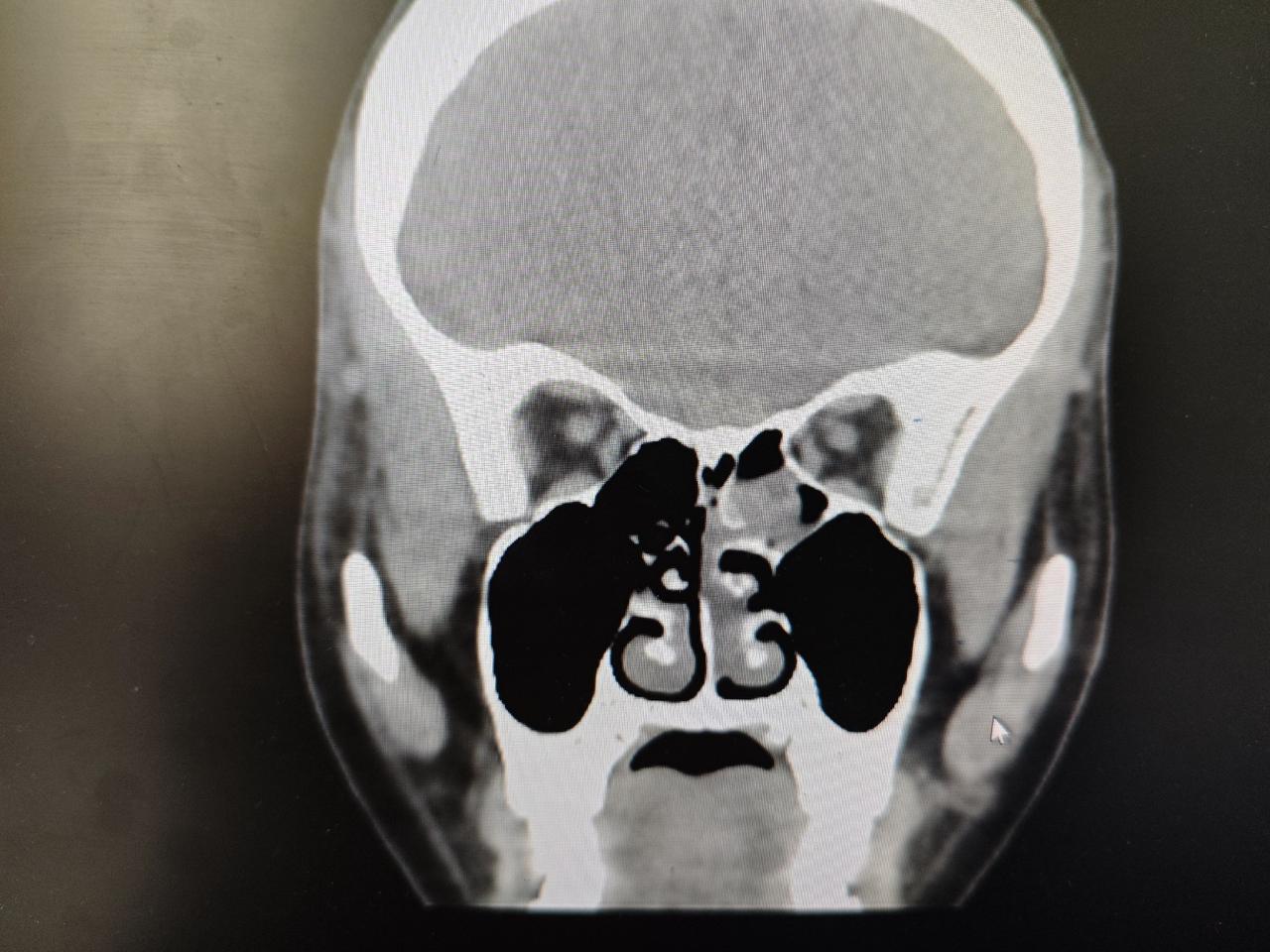 内翻性乳头状瘤，术后半年复查，预后良好