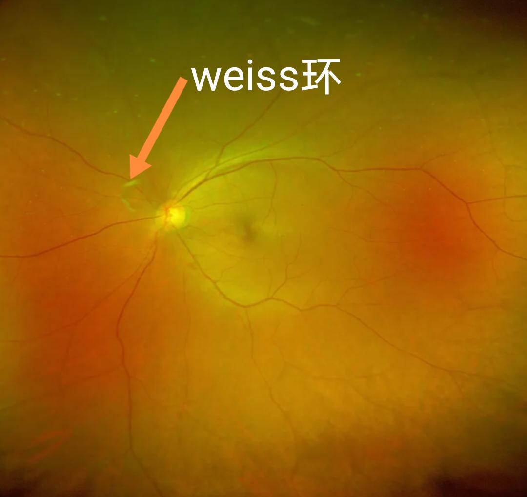 玻璃体后脱离之眼底weiss环！！！