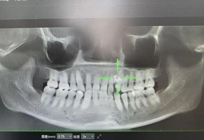 浙江诸暨，一女子因持续牙痛就医，CT一查竟发现上颌骨内密密麻麻堆积着大量牙体样组