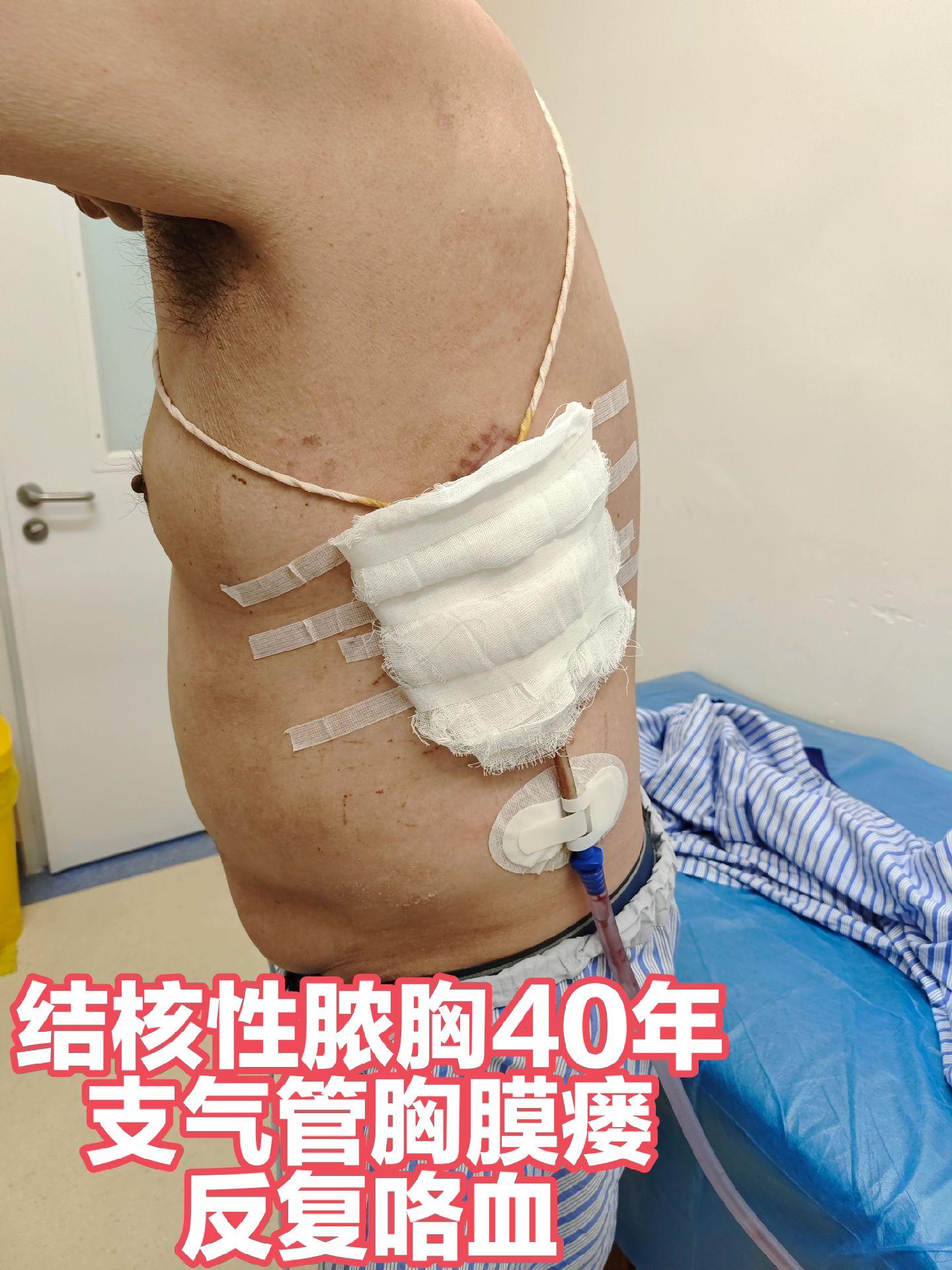 迄今为止，最大脓腔修复。脓胸（支气管胸膜瘘）在上海七院，更强效、微创...