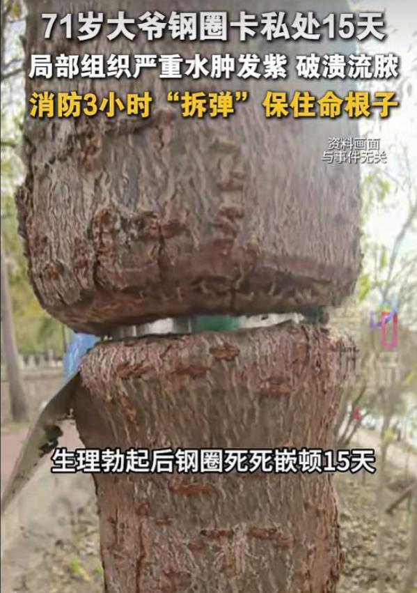“活久见！”2026年4月下旬，广州一位 71 岁的老伯，听信偏方将两个金属钢圈