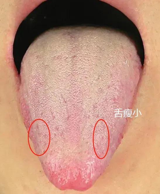当我们谈及肝气郁结，这一中医术语可能让很多人感到陌生。然而，它却是肝脏疾病中相当