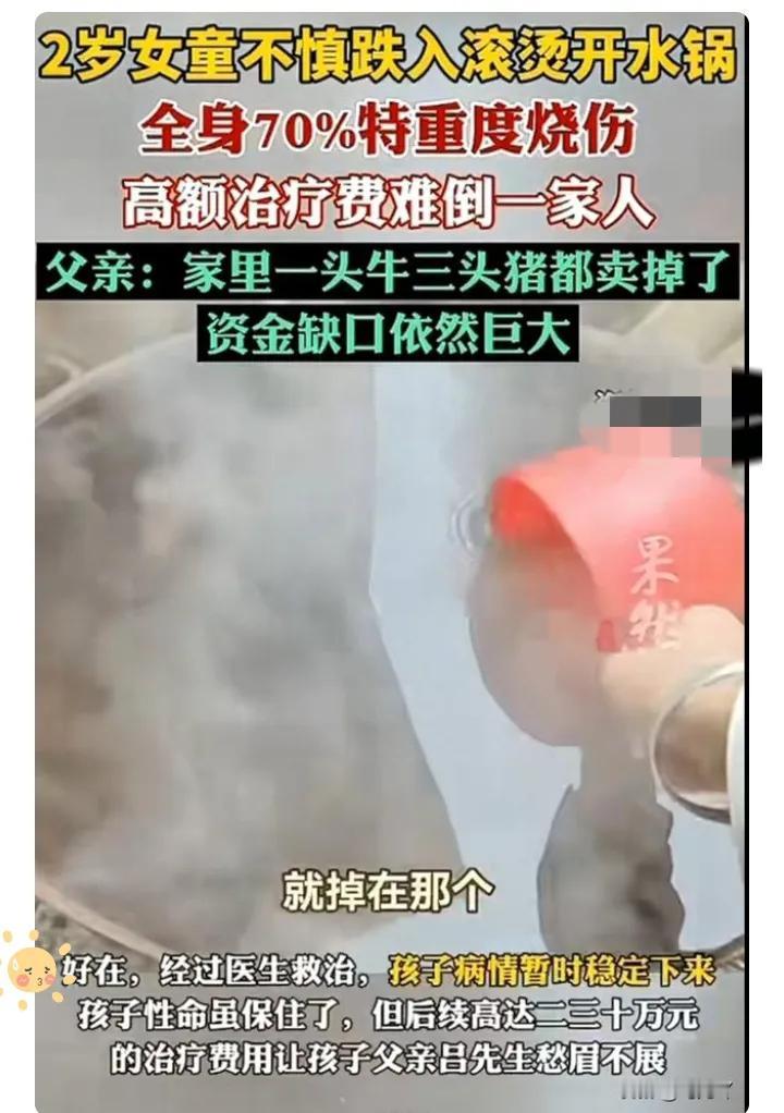 两岁娃掉开水锅！70%烧伤要30万救命，愤怒后别只骂家长
 
贵州两岁女童跌进开