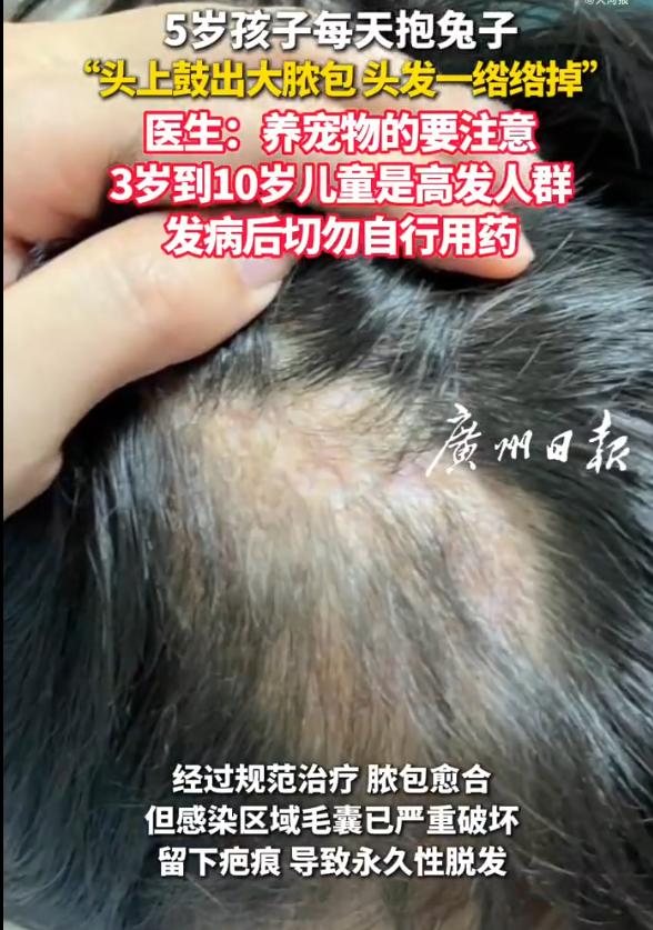 [酷拽]“最担心的事情还是发生了！”浙江宁波，5岁女孩因每天抱邻居家兔子后揉头皮