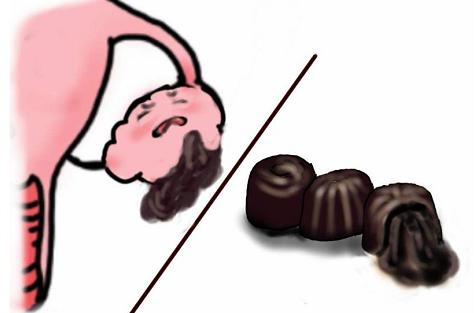 #健康真探社#【多半巧克力囊肿术后会复发？这样预防才有效！】巧克力囊肿是一种由于