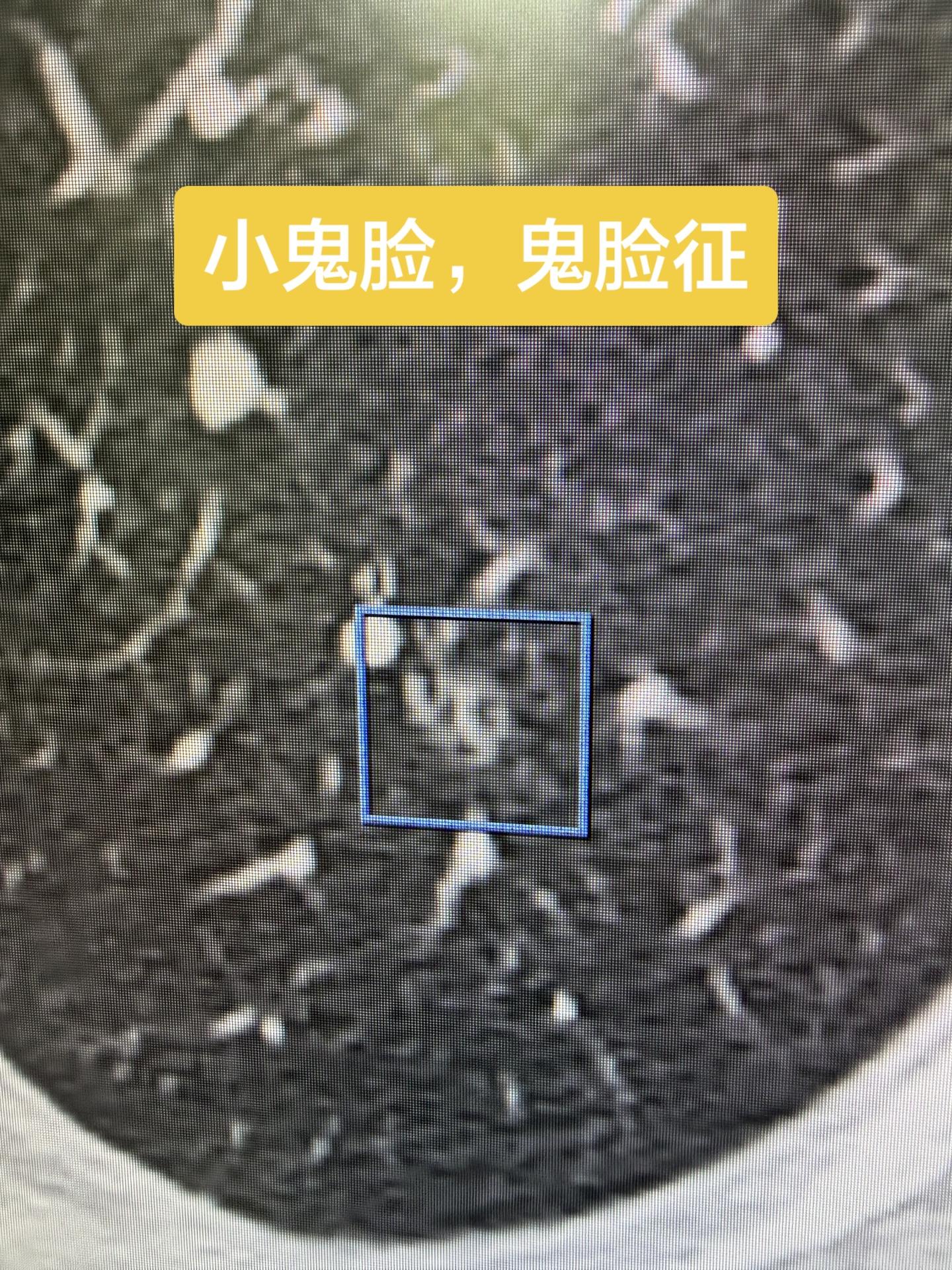 小鬼脸，鬼脸征