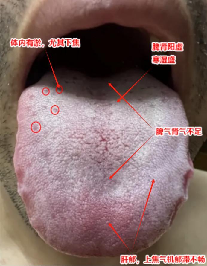 看这个舌象，典型的“ 肝郁 脾肾阳虚  ”，但用再多逍遥散，桂附理中丸都没用！
