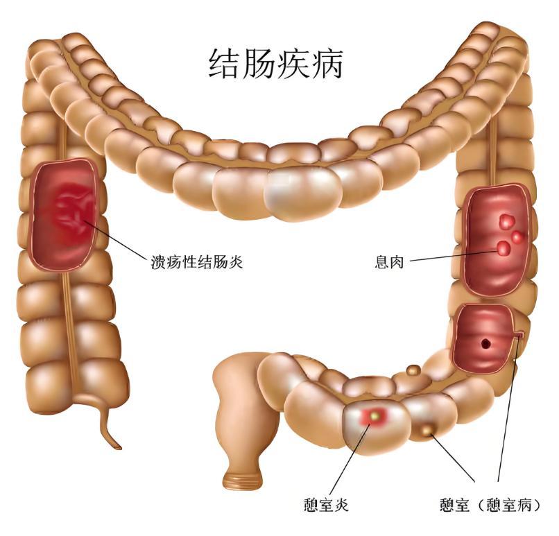 疡性结肠炎8年，调理一个星期，脓液血便消失了
患者32岁间断性腹泻、黏液脓血便1