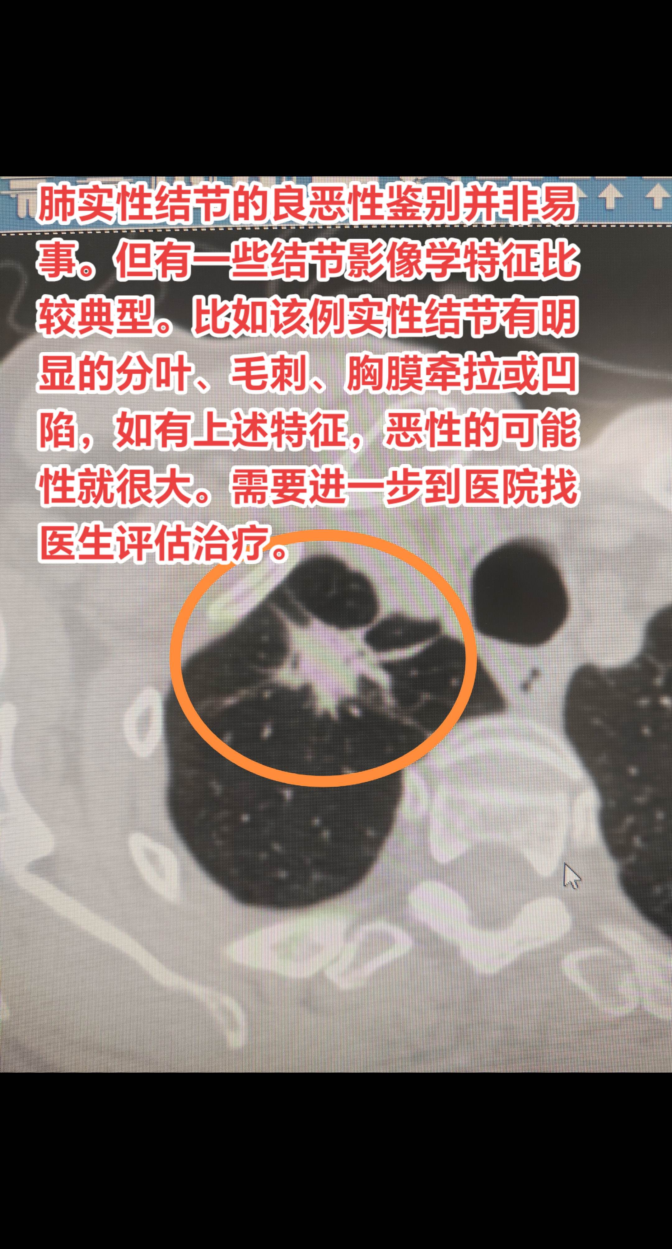 肺实性结节的良恶性鉴别并非易事。但有一些结节影像学特征比较典型。比如该...