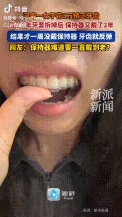 河南一姑娘为了美，砸了3万块矫正牙齿。牙套老老实实戴了3年，好不容易拆掉，又乖乖