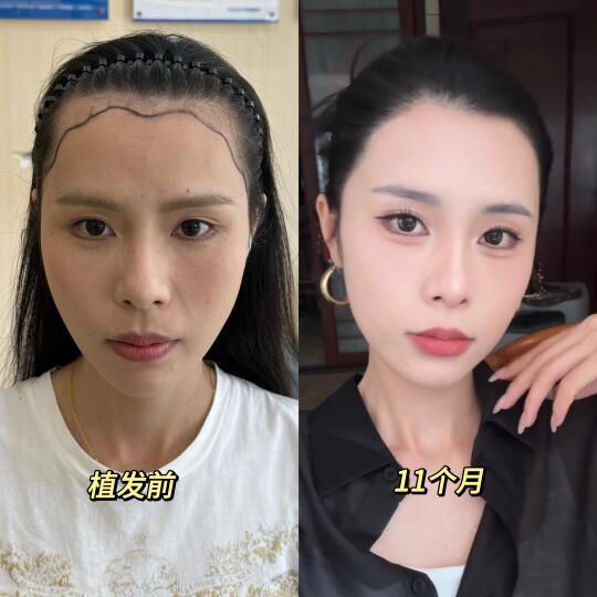 发际线11个月，前后变化｜想二植